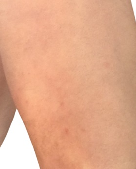 Eczema après
