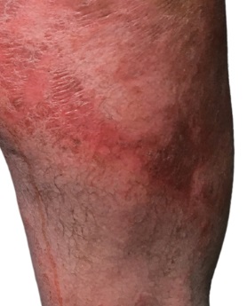 Eczema avant Eczema avant